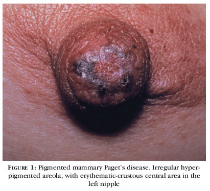 cancer pagents breast